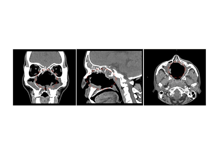 Immagine condrosarcoma postoperatoria