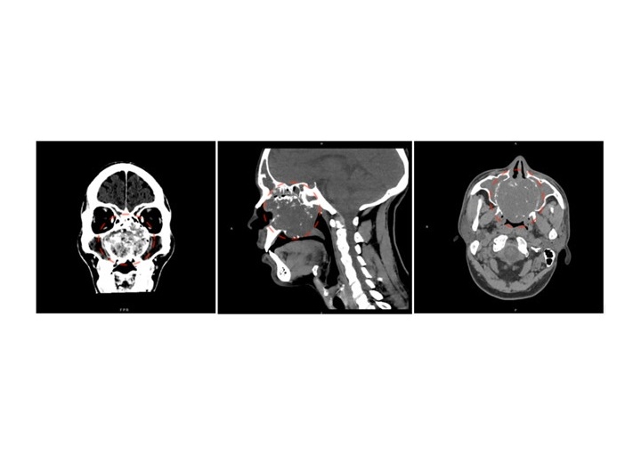 Immagine condrosarcoma preoperatoria