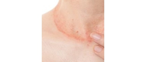 Psoriasi, a Trieste un ambulatorio specializzato nella diagnosi e cura