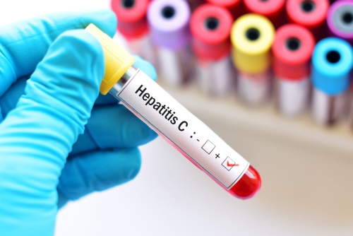 Presejalni program za hepatitis C: brezplačna priložnost za zgodnje odkrivanje okužbe in prispevek k odpravi virusa