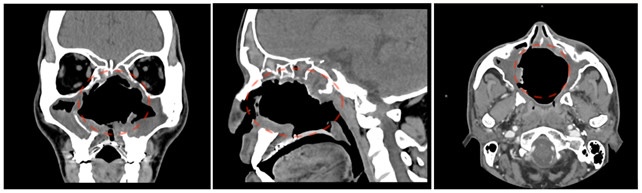 Immagine condrosarcoma postoperatoria