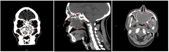 Immagine condrosarcoma preoperatoria